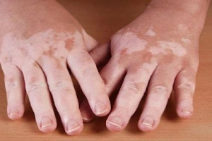 Nam giới mắc bạch biến điều trị như thế nào?