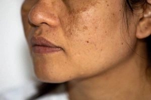 Nám tàn nhang lâu năm điều trị được không?
