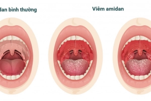 Nang amidan trong cổ họng có nên phẫu thuật không?