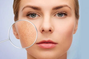 Nang lông bị tắc nghẽn, vì sao?