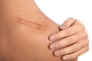 Nên kiêng ăn gì để không bị sẹo?