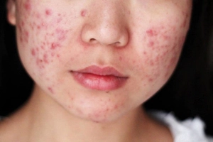 Nên uống thuốc trị mụn hay nên bôi ngoài da?