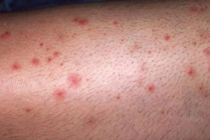 Ngứa chân tay kèm lở loét có sao không?