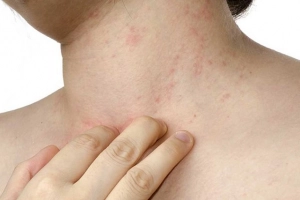 Ngứa da sau uống thuốc kháng sinh có sao không?