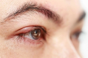 Ngứa mí mắt, nổi mẩn ngứa ở da khi thay đổi thời tiết là bệnh gì?