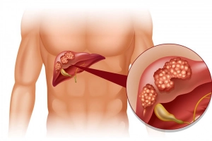 Người bệnh thận đa nang bị huyết áp không ổn định có sao không?