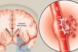 Người bệnh xuất huyết não bao ngoài kèm đái tháo đường nên ăn uống thế nào?