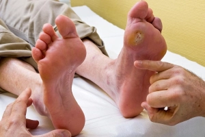 Người bị loét bàn chân tiểu đường có dấu hiệu thế nào?