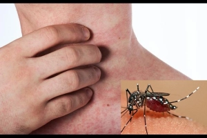 Người bị sốt xuất huyết uống thuốc gì?