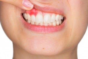 Người bị viêm lợi có nên lấy cao răng thường xuyên không?