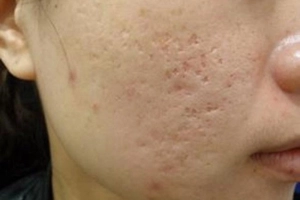 Người da nhạy cảm có sẹo rỗ do mụn trên mặt điều trị như thế nào?