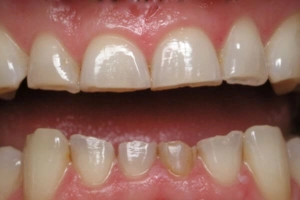 Người lớn bị mòn răng phải làm sao?