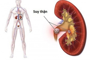 Người suy thận mạn độ 3a đi tiểu 2 lần/ngày phải làm sao?