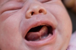Nguy cơ ngọng ở trẻ bị ngắn lưỡi