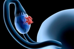 Nguy cơ ung thư buồng trứng sau phẫu thuật cắt tử cung