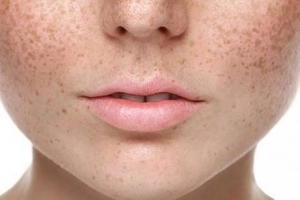 Nguyên nhân gây nám da tàn nhang ở phụ nữ