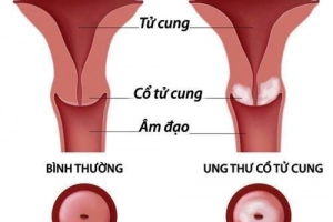 Nguyên nhân gây ra bệnh ung thư cổ tử cung là gì?