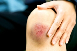 Nguyên nhân khiến vết thương sưng tấy