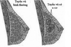 Nguyên nhân và các dấu hiệu của xơ nang tuyến vú