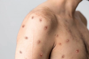 Nhận biết bệnh đậu mùa khỉ qua hình ảnh