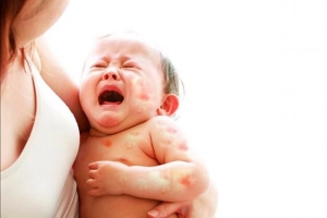 Nhận biết và xử trí dị ứng đạm sữa bò ở trẻ
