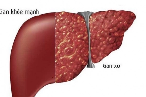 Nhiễm Covid-19 ở bệnh nhân xơ gan