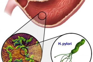 Nhiễm Helicobacter pylori và các biểu hiện ở ngoài dạ dày