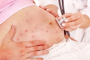 Nhiễm rubella khi mang thai, sinh bé có bị nhiễm bệnh không