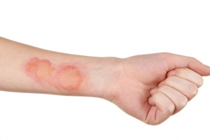 Nhiễm trùng da: Những điều bạn nên biết