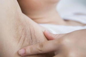 Nhổ lông nách có gây viêm lỗ chân lông?