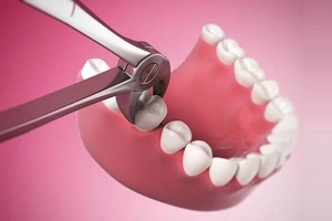 Nhổ răng bao lâu thì trồng lại được?