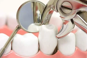 Nhổ răng để niềng có ảnh hưởng gì không?
