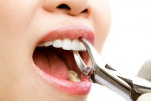 Nhổ răng giảm tuổi thọ: Tin đồn hay sự thật?
