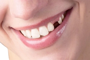 Nhổ răng số 4 có ảnh hưởng gì không?