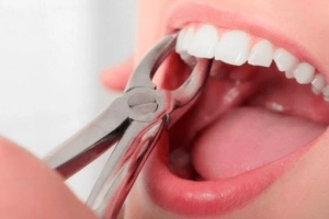 Nhổ răng số 5 hàm trên và dưới có nguy hiểm không?