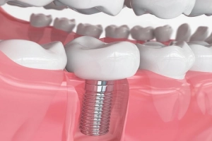 Nhổ răng số 7 có cần trồng lại không?