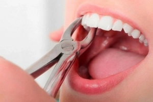 Nhổ răng vĩnh viễn có ảnh hưởng gì đến thần kinh không?