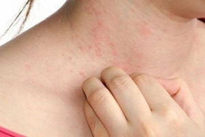Những bệnh ngoài da mùa hè thường gặp