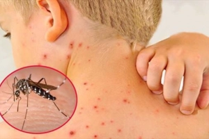 Những biểu hiện cảnh báo sốt xuất huyết ở trẻ
