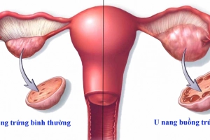 Những cách điều trị u nang buồng trứng