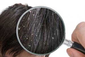 Những điều cần biết về bệnh gàu