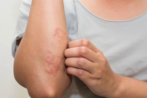 Những điều cần biết về bệnh viêm da cứng