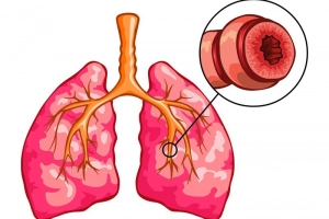 Những điều cần biết về co thắt phế quản