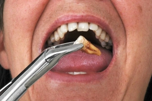 Những điều cần biết về nhổ răng sâu hàm trên