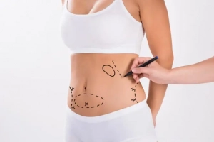 Những điều nên biết khi hút mỡ (liposuction)