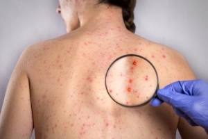 Những hiểu biết cơ bản về bệnh Rubella