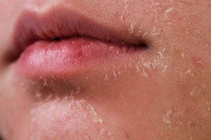 Những nguy cơ mắc bệnh về da mùa đông
