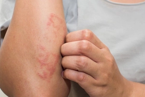 Những tác nhân gây bệnh chàm hàng đầu cần tránh