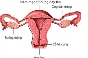 Nội mạc tử cung dày là sao, báo hiệu điều gì?