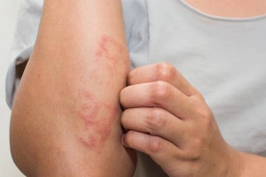 Nổi mày đay hậu COVID-19